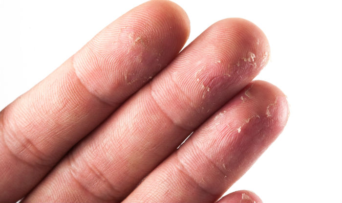 how to get rid of cracked dry peeled fingers at home 1