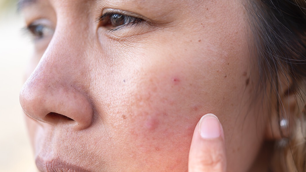 how to take care of acne prone skin in summer1