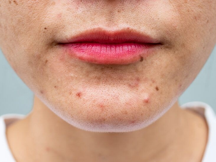 how to take care of acne prone skin in summer2